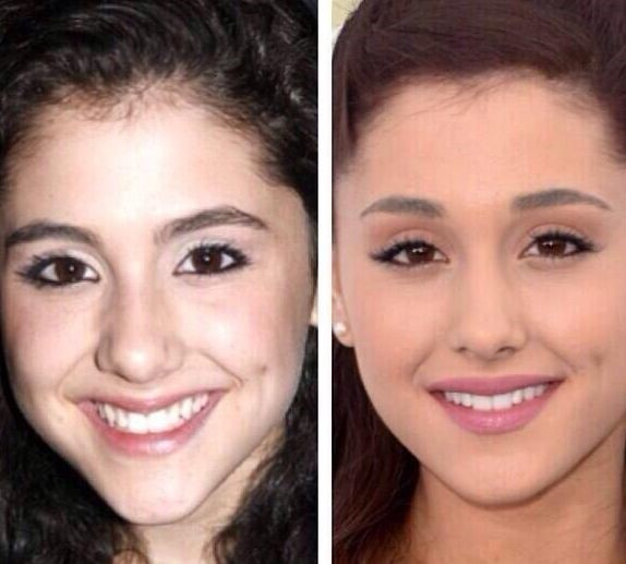 Ariana Grande Before And After Plastic Surgery 02 Celebrity Plastic