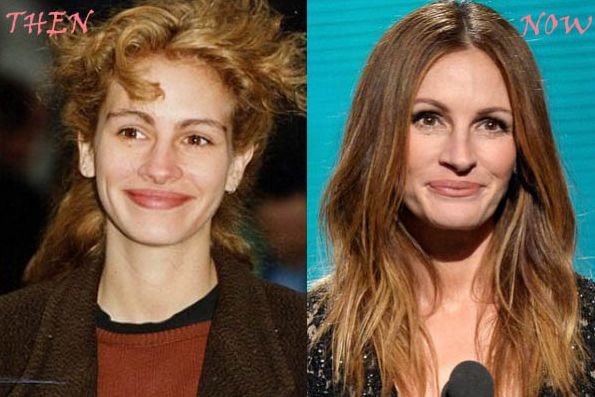 Julia Roberts Plastic Surgery Then And Now Celebrity Plastic