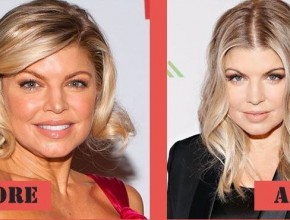 Fergie before and after plastic surgery