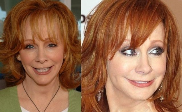 Reba McEntire before and after plastic surgery | Celebrity plastic ...