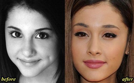 Ariana Grande before and after plastic surgery 03 – Celebrity plastic ...