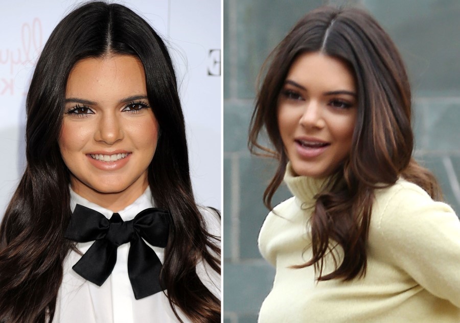 Kendall Jenner before and after plastic surgery 02 – Celebrity plastic ...