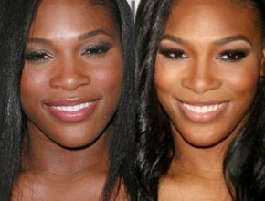 Serena Williams before and after plastic surgery 03