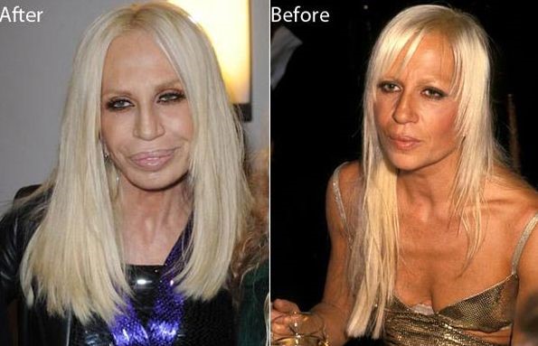 Donatella Versace after and before plastic surgery – Celebrity plastic ...