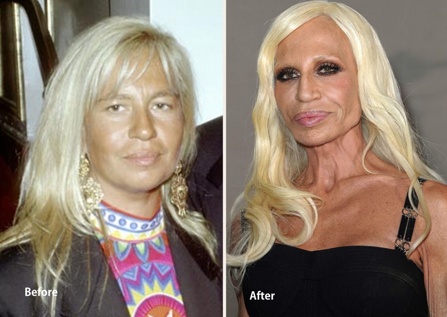 Donatella Versace before and after plastic surgery 07 – Celebrity ...