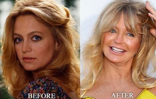 Goldie Hawn before and after plastic surgery 04 – Celebrity plastic ...