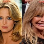 Goldie Hawn plastic surgery face lift for removing wrinkles