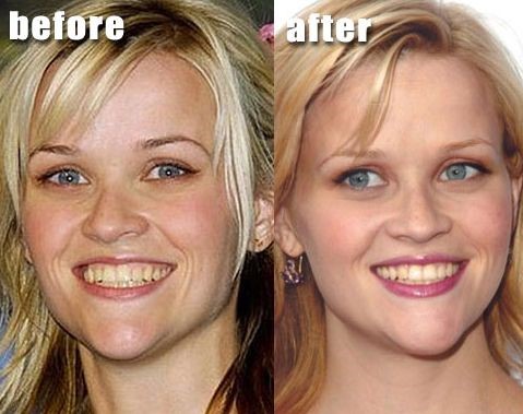 Reese Witherspoon before and after plastic surgery 05 – Celebrity ...