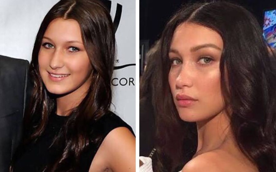 Bella Hadid plastic surgery and modeling