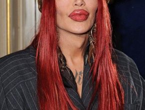 Pete Burns plastic surgery 20