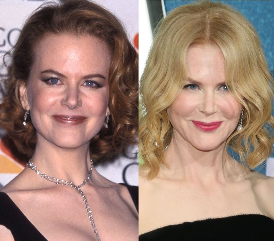 Nicole Kidman before and after plastic surgery (18) Celebrity plastic