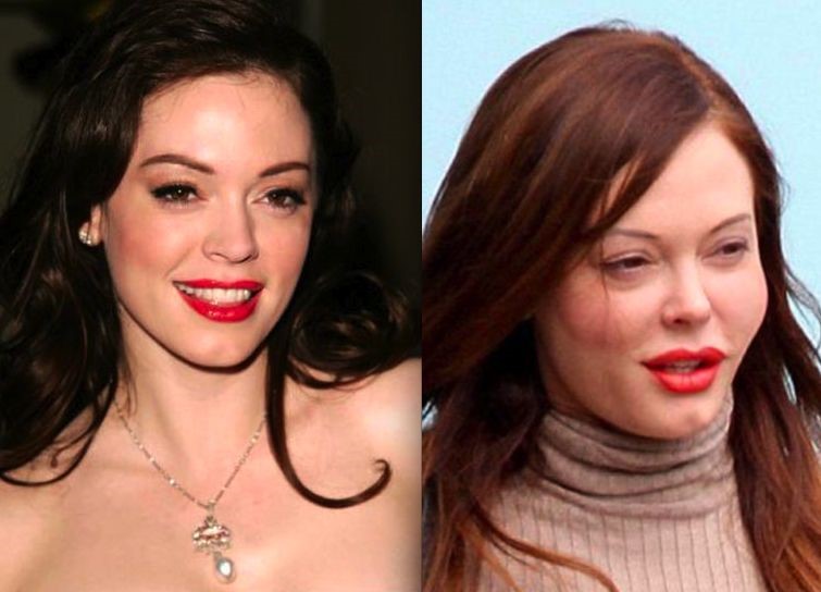 Rose McGowan before and after plastic surgery (1) Celebrity plastic surgery online