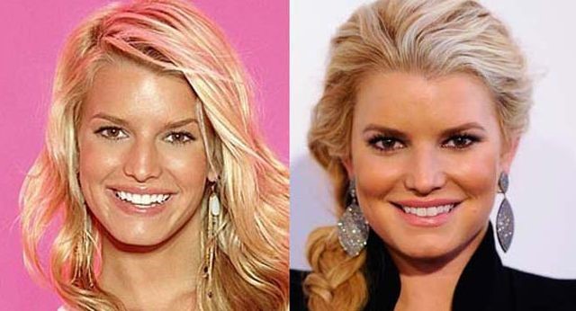 Jessica Simpson before and after plastic surgery (20) – Celebrity ...