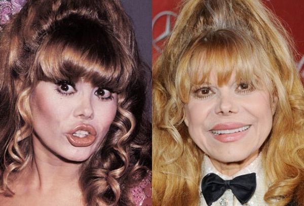 Charo before and after plastic surgery – Celebrity plastic surgery online