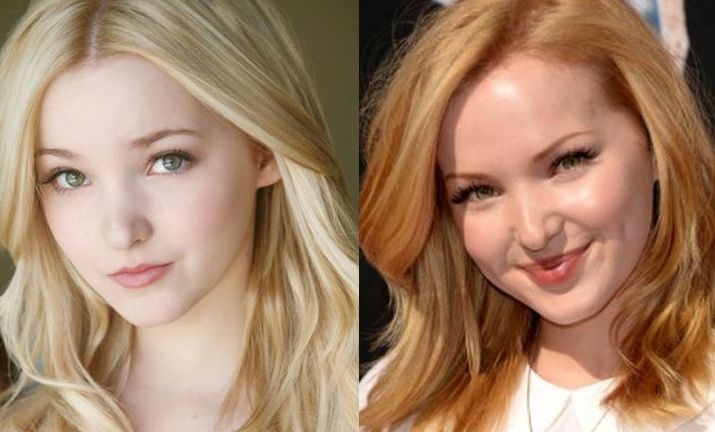Dove Cameron plastic before and after surgery (14) – Celebrity plastic ...